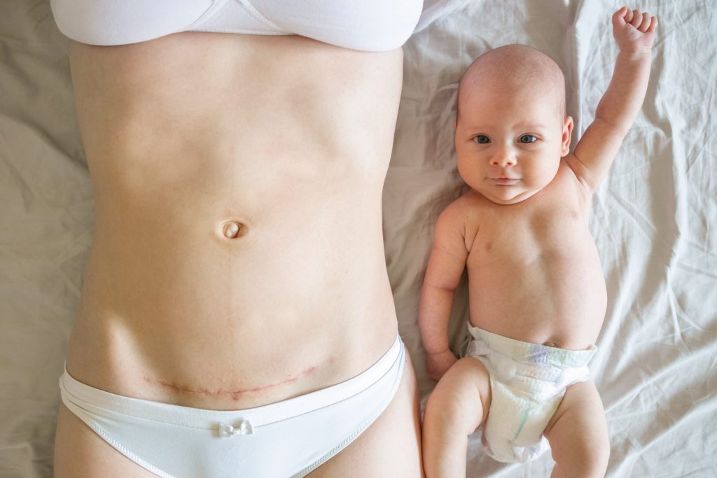 Image of a mom and baby lying on a bed. The mom's c-section scar is visible.